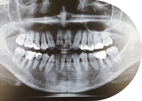 向ヶ丘遊園の一般歯科治療で活用するレントゲン設備