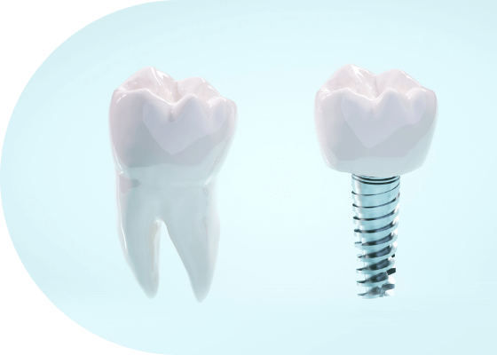向ヶ丘遊園の一般歯科治療で活用するインプラント3Dガイド設備
